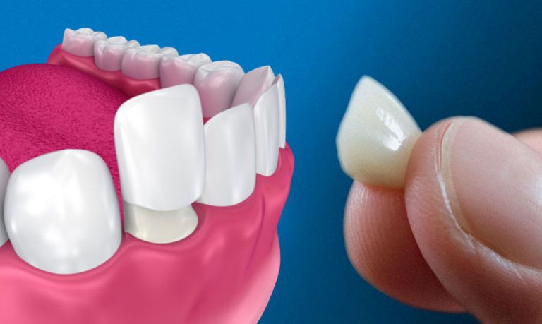 vantaggi-faccette-denti-bianchi-768x459-min