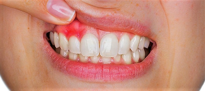 Afectiuni-parodontale