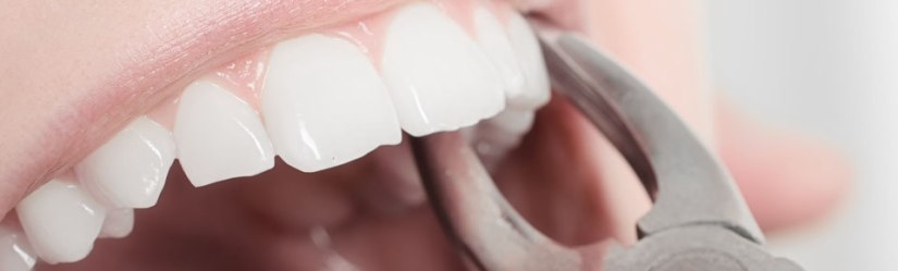 Tooth-Extraction-Star-Care-Dental-Glen-Mills-PA